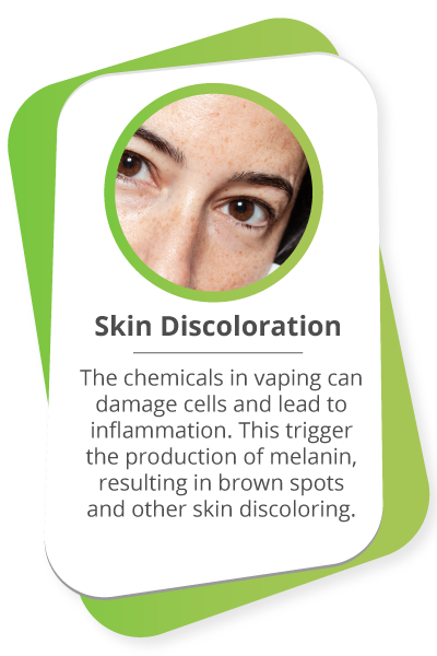 Skin Discoloration: The chemicals in vaping can damage cells and lead to inflammation. This trigger the production of melanin, resulting in brown spots and other skin discoloring.